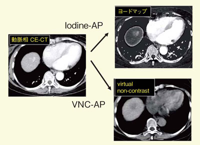 図4　肝細胞がん（HCC）の動脈相画像から作成したVNC