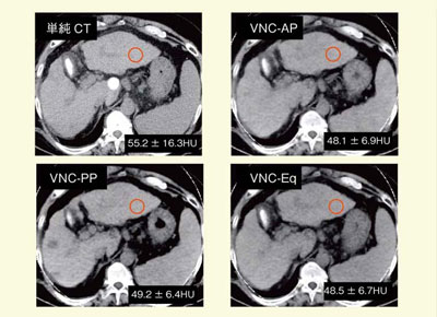 図5　単純CTとVNCの背景肝臓CT値の比較