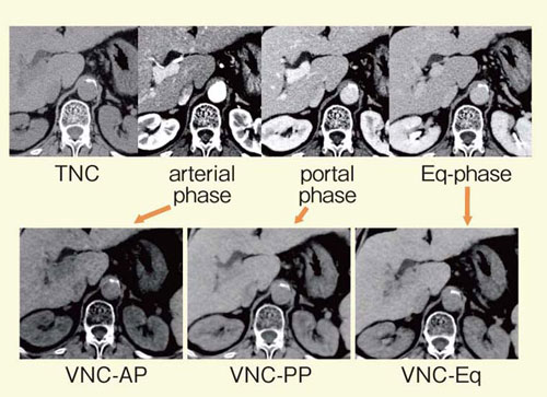 図6　大動脈石灰化症例のVNC