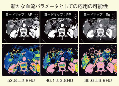 図8　肝細胞がんの造影CTで各相のヨードマップからヨード量の変化を算出