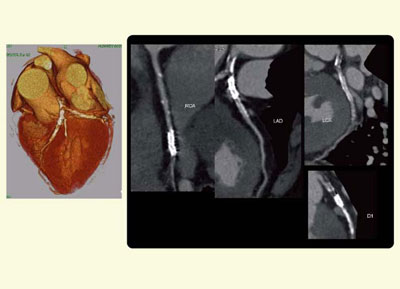 図2　症例2：冠動脈CTAでは評価困難な症例