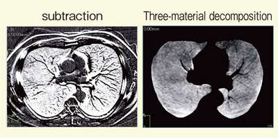 図6 subtractionとThree-materialdecompositionの画像の比較