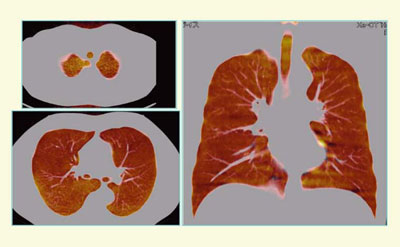 図7　症例1（60歳，男性，非喫煙者）：Three-material decomposition画像