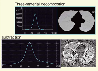 図9　症例1：Three-material decompositionとsubtractionのCT値ヒストグラムの比較