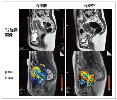 }1@Comparison of Pre-Post NAC, Ktrans in Cervical CanceriMAGNETOM Skyra Ver D11j iCourtesy of Kyoto University Hospital, Japan.j