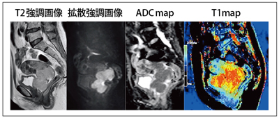 }2@ T1map image for Cervical Cancer iMAGNETOM Skyra Ver D11j iCourtesy of Kyoto University Hospital, Japan.j