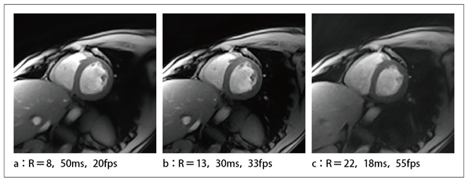 }2@ Compressed SensingɂCINE摜 iRFReduction Factorj