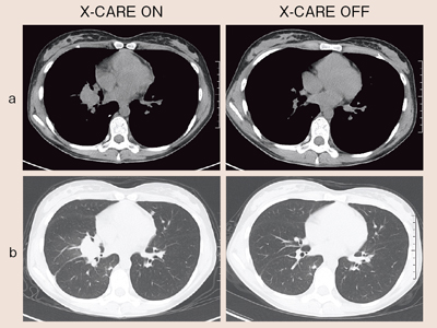 図6 胸部単純CT(17歳,女性)