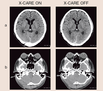 図8 頭部単純CT(56歳,男性)