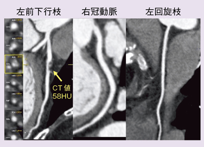 }4@Ǘ1FFlash Spiral CardioCPR摜