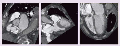 図9 症例4:感染性心内膜炎