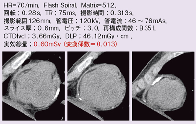 図5 症例5:収縮性心膜炎のMPR像
