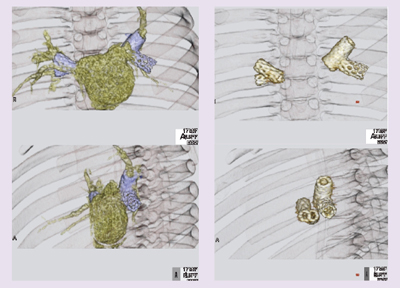 図6 症例6:総肺静脈還流異常症術後の肺静脈狭窄ステント留置術のVR像