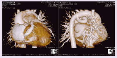 図7 症例7:肺動脈閉鎖症,右室低形成,LCA右室瘻,動脈管開存症のVR像
