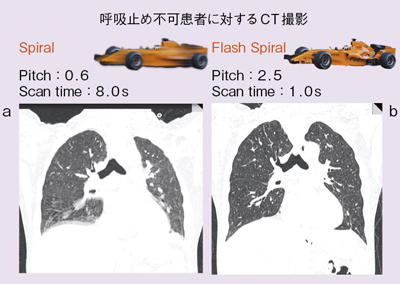 図2 症例1:通常のヘリカルスキャン(a)とFlash Spiral(b)におけるモーションアーチファクトの比較