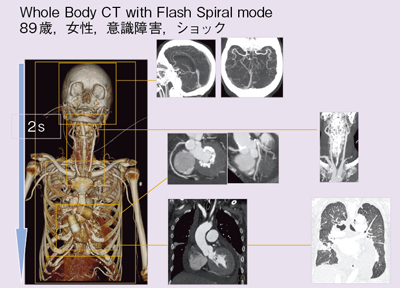 図3 症例2:Flash Spiralにて頭部から胸部までの造影CTを施行