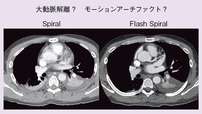 図4 Flash Spiralによるモーションアーチファクト軽減効果の検討