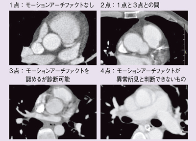 図5 モーションアーチファクト軽減効果の評価方法