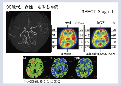 図2 症例1:右内頸動脈閉塞のもやもや病