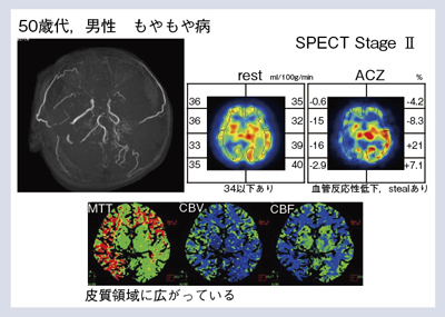 図3 症例2:両側内頸動脈閉塞のもやもや病