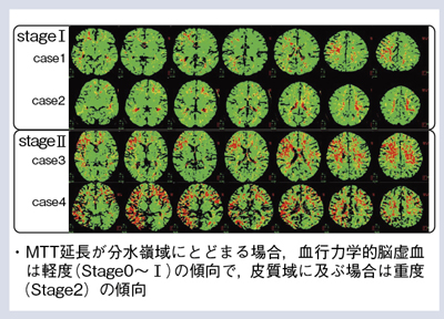 図4 MTTの延長域の分布からもやもや病の重症度を推測