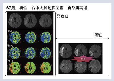 図5 症例3:右中大脳動脈閉塞(自然再開通)