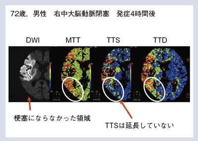 図6 症例4:右中大脳動脈閉塞(非再開通)