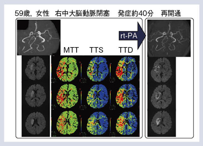 図7 症例5:右中大脳動脈閉塞(再開通)