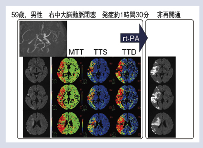 図8 症例6:右中大脳動脈閉塞(非再開通)