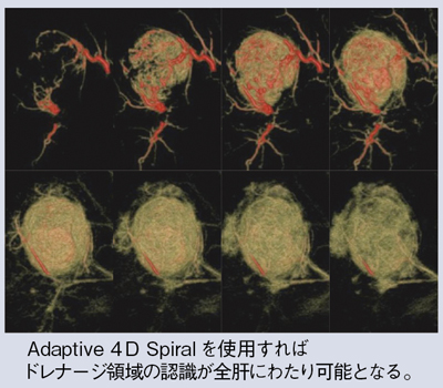 図4 64MDCTによる3D-CTHAの経時的観察
