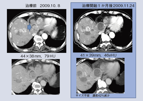 図5 HCCに対するSorafenib治療開始後の画像変化