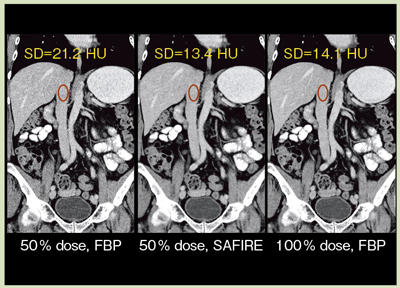 図9 臨床例によるSAFIREの線量低減効果の比較