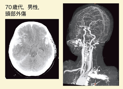 }3@head bone removalɂMIP摜