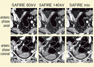図8 症例3:80kV,140kVの composite image(SAFIRE併用)