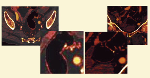 図9 症例3:75%ブレンドiodine image(SAFIRE併用)