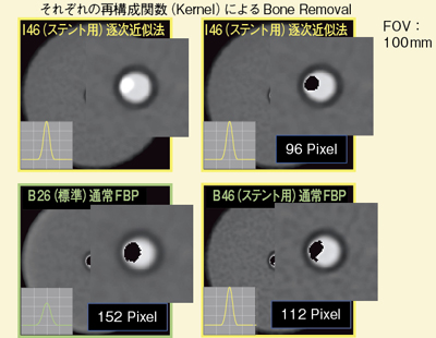 図6 ファントムによるIRISとFBP法の比較