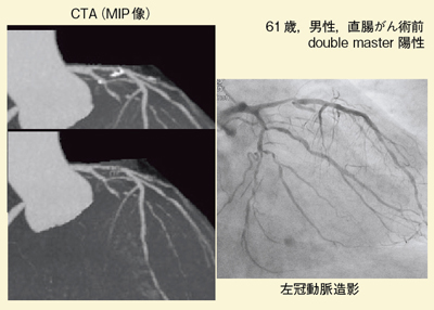 図11 症例2:IRISによる石灰化除去症例 直腸がん術前