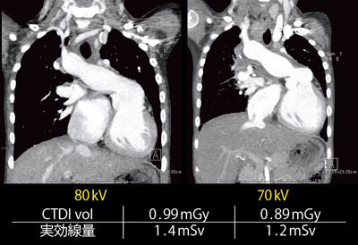 }9@Ǔd70kV80kV̉摜̔r 6΁CCxCSuCMAPCAs rt UnifocalizationCbil m-BTVg