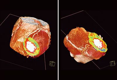 }6@Ǘ2Fperfusion map