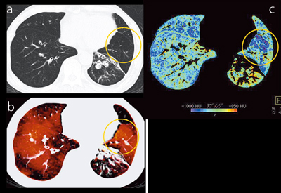 }3@Ǘ1FxCCGOLDUixj aFPCT@bFXeC[W@cFparenchyma摜