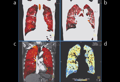 }5@Ǘ1FxCCGOLDUiRi摜j aFXeC[WizCj@bFXeC[WiċCj cFLung PBV@dFparenchyma摜iċCLAAj