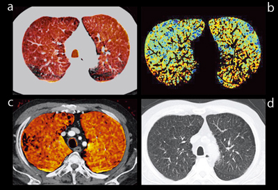}7@Ǘ2FCPFEi72΁CjjCxCALV摜 aFXeC[W@bFparenchyma摜 cFLung PBV@dFPCT摜