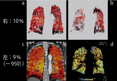 }8@Ǘ2FCPFEi72΁CjjCRi摜 aFXeC[WizCj@bFXeC[WiċCj cFLung PBV@dFparenchyma摜