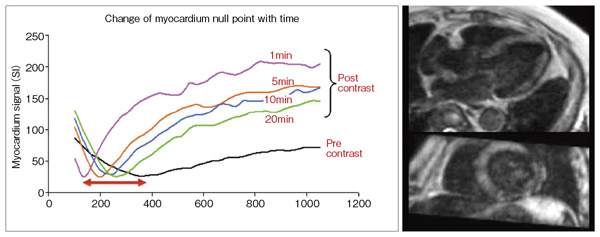 図3　造影剤注入後の正常心筋の至適TI値の時間変化グラフと至適TI値がずれてしまった場合の3D遅延造影画像
