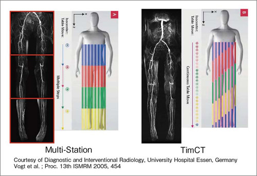 図4　造影MRA撮像：マルチステーション vs. TimCT Angiography