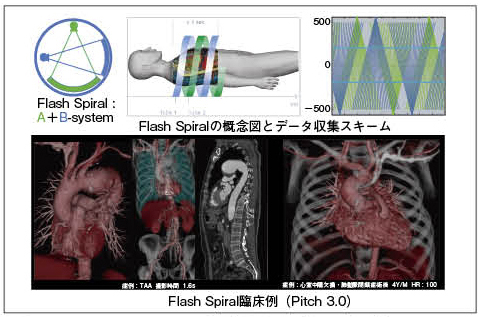 図1　Flash Spiralの概念図とデータ収集スキームと臨床例（画像ご提供：榊原記念病院様）