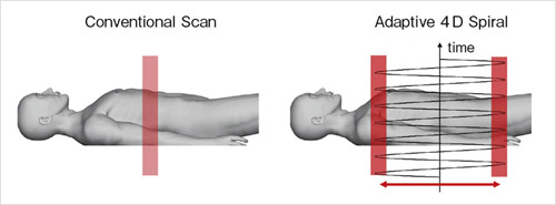 図2　Conventional ScanとAdaptive 4D Spiralの比較