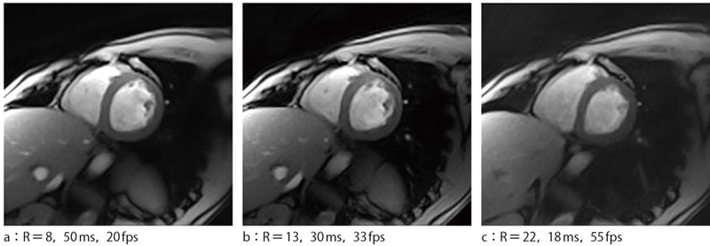 }3@Compressed SensingɂCINE摜 iRFReduction Factorj