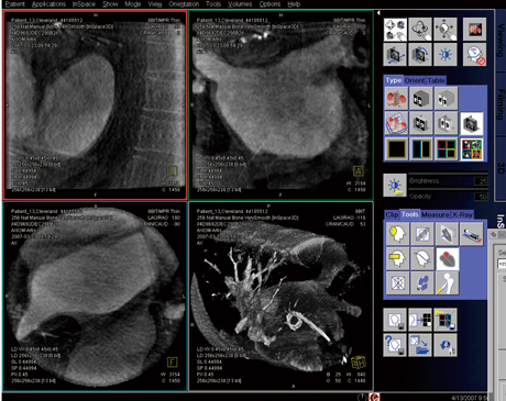 }6@syngo DynaCT Cardiac