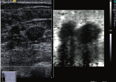 }2@Virtual Touch Tissue Imaging̗iZǊj